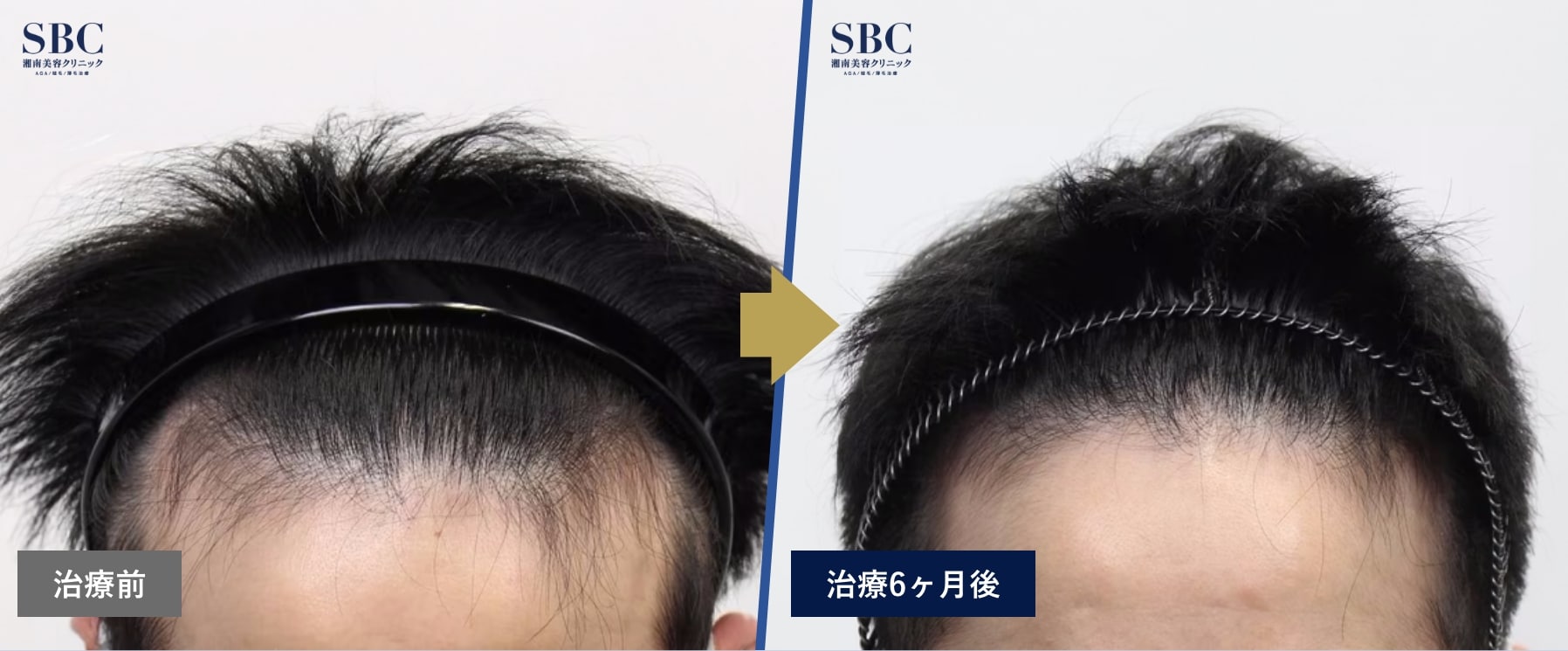 【症例写真】AGA治療薬＋ノンシェーブン植毛の治療前と治療｛6ヵ月後｝