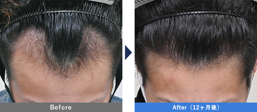 40代男性1350GのスマートFUE植毛の症例写真