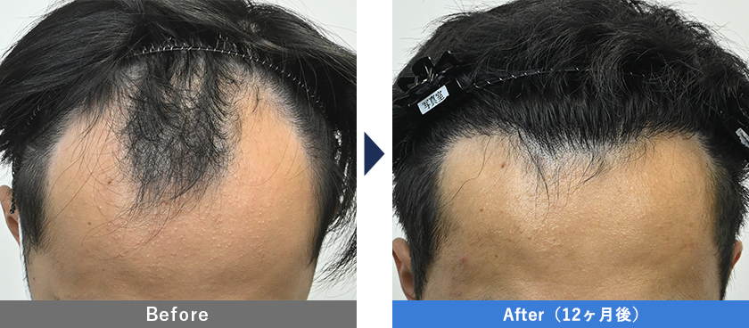 20代男性1000GのスマートFUE植毛の症例写真