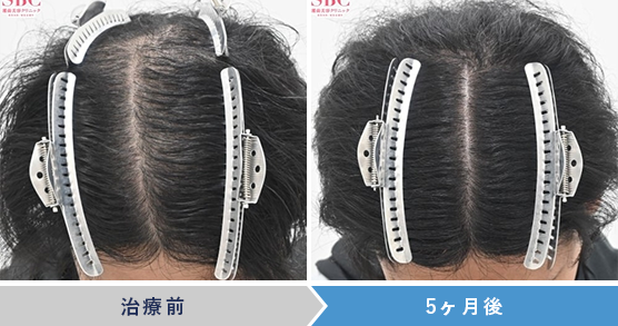 AGA治療薬の症例写真 治療前 治療5ヶ月後