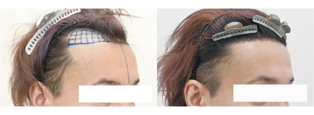 自毛植毛1000Gの症例写真 治療前と治療12ヶ月後の比較
