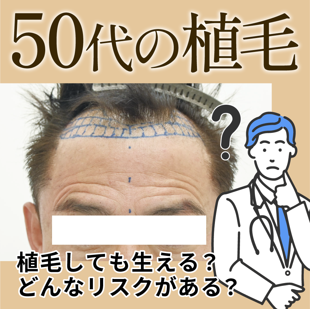 【50代で植毛】高齢者の植毛は失敗しやすい？植毛医が解説します【湘南AGAクリニック福岡院】