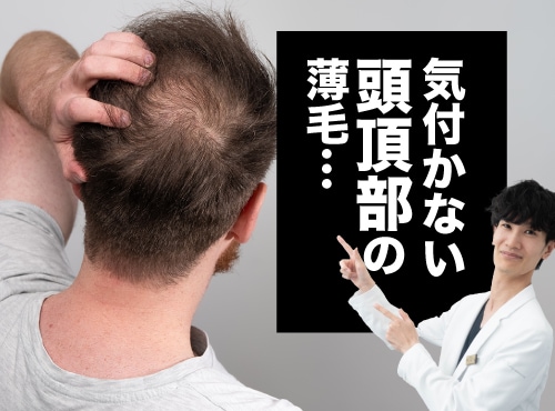 自分が想像しているよりも薄毛は進行しているかも…