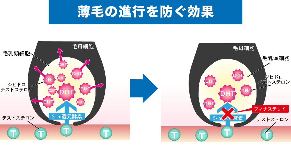 AGA薬フィナステリドの効果①