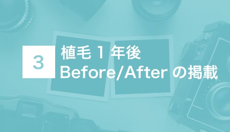 植毛手術1年後のBefore/Afterの掲載