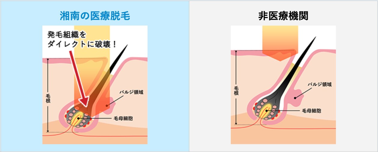 高出力で照射ができる