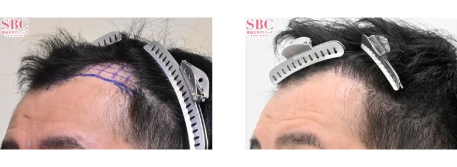 AGA治療薬+自毛植毛 治療前と治療12ヶ月後の比較