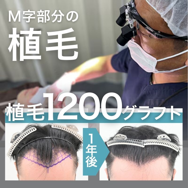 【徹底解説】学生さんでも大丈夫！予算に合わせたAGA治療をご提案します。-20代男性の治療解説-