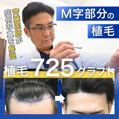 【徹底解説】少ないグラフト数でM字改善！スリットが自毛植毛成功の鍵-20代男性の治療解説-