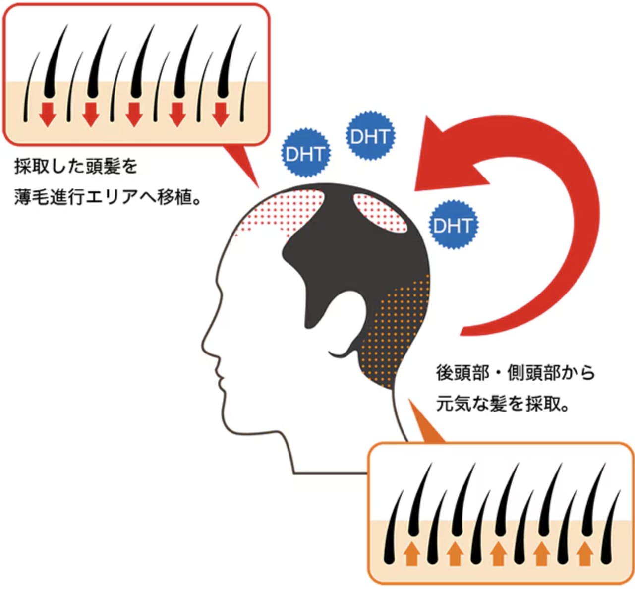 湘南AGAクリニックの自毛植毛