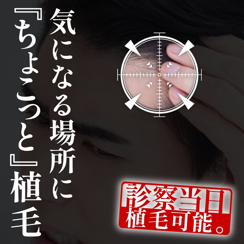 診察当日に植毛可能！髭・もみあげ・眉毛・頭皮の傷跡をデザイン【ちょこっと植毛】