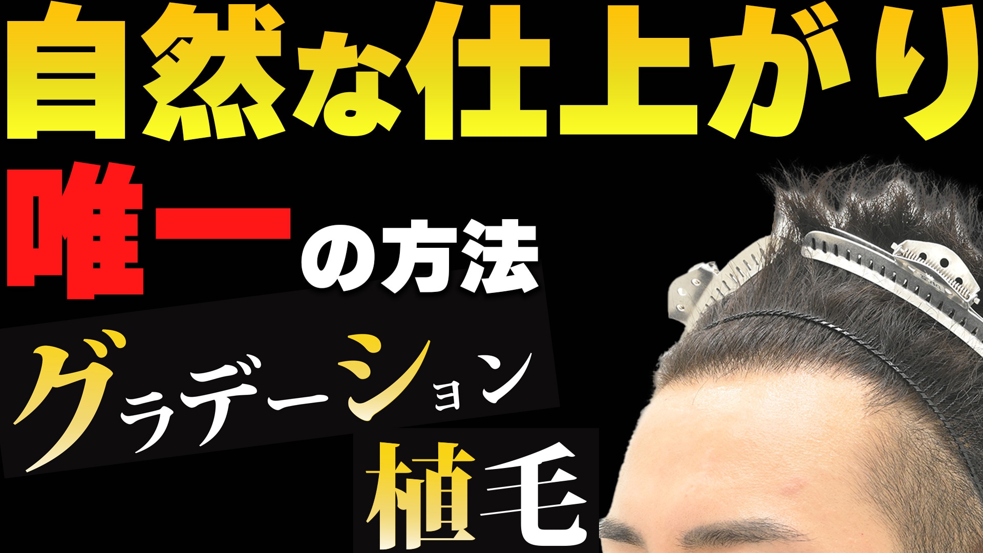 【自毛植毛】自然で綺麗な仕上がりになるグラデーション植毛がどんな植毛なのか解説！